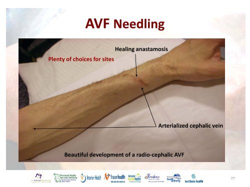 Vascular Access Module #3: AVF Maturation ... - BC Renal Agency