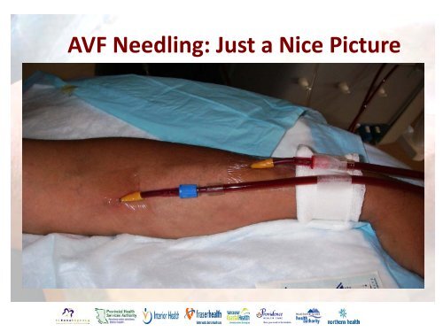 Vascular Access Module #3: AVF Maturation ... - BC Renal Agency