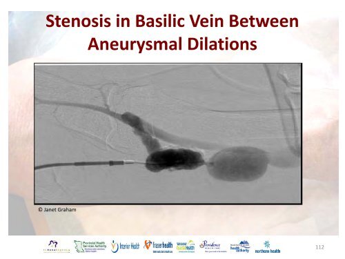 Vascular Access Module #3: AVF Maturation ... - BC Renal Agency