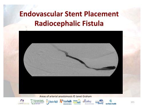 Vascular Access Module #3: AVF Maturation ... - BC Renal Agency