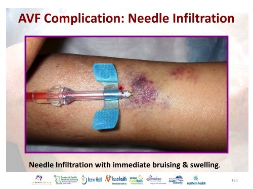 Vascular Access Module #3: AVF Maturation ... - BC Renal Agency