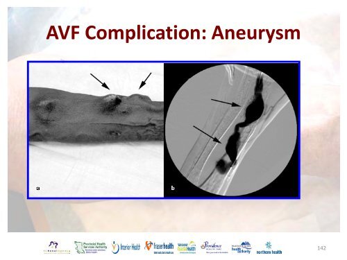 Vascular Access Module #3: AVF Maturation ... - BC Renal Agency