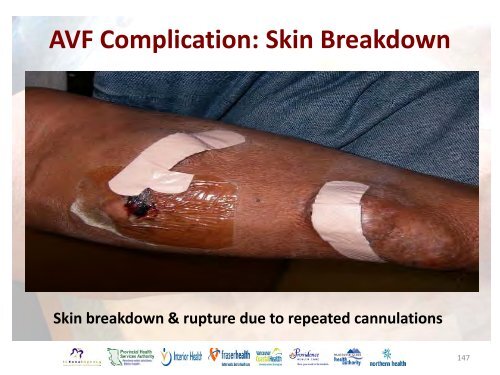 Vascular Access Module #3: AVF Maturation ... - BC Renal Agency