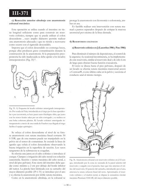 Técnicas de resección en patología rectal - Sacd.org.ar