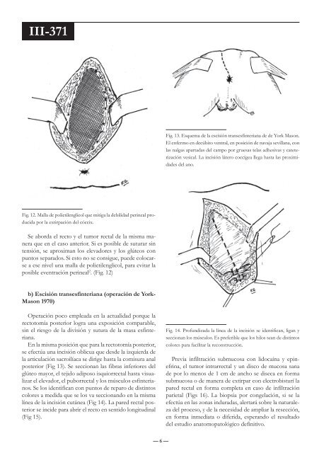 Técnicas de resección en patología rectal - Sacd.org.ar