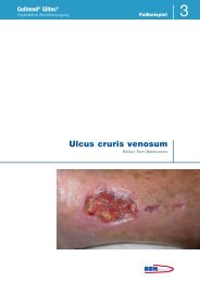 Ulcus cruris venosum - Cutimed