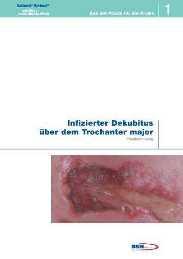 Infizierter Dekubitus über dem Trochanter major - Cutimed Sorbact
