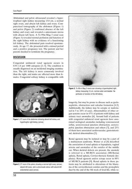 Association of unilateral renal agenesis and genital anomalies