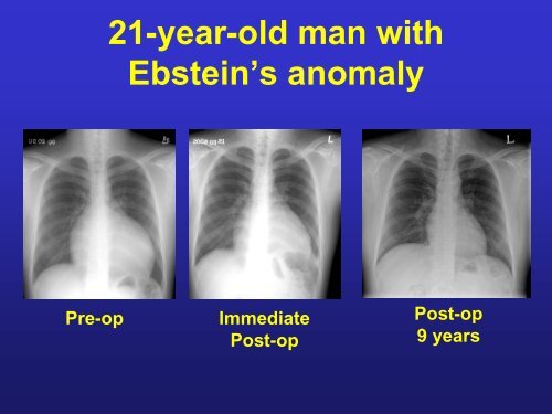 Ebstein anomaly