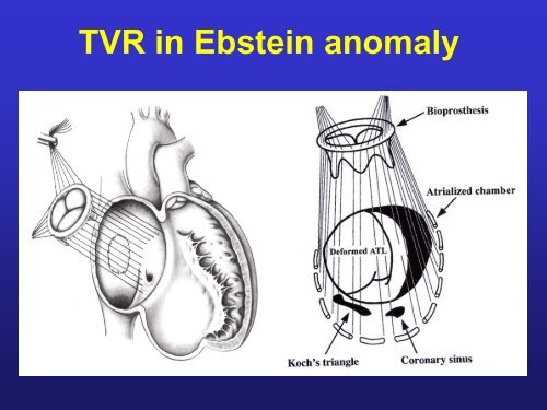 Ebstein anomaly