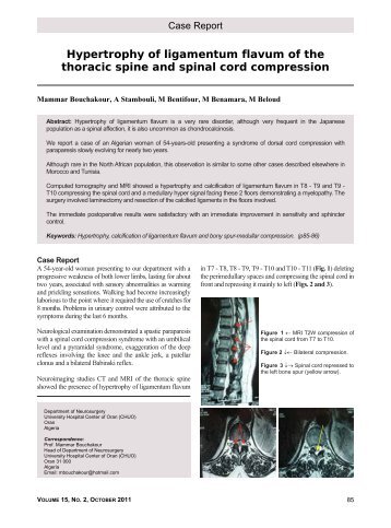 Hypertrophy of ligamentum flavum of the thoracic spine and spinal ...