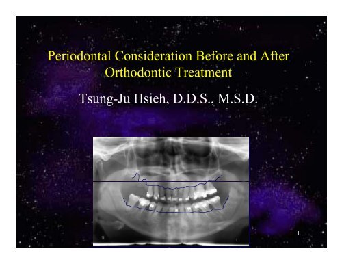 Periodontal Consideration Before and After ... - Dr. Frank Hsieh