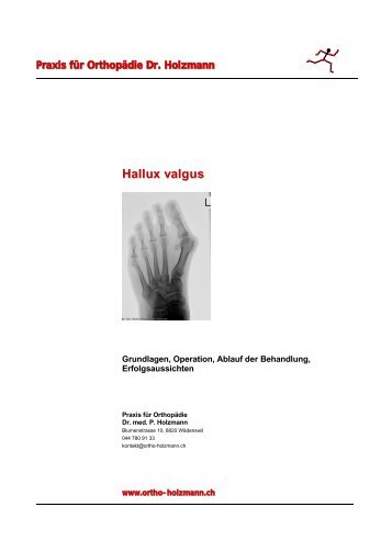 Hallux valgus - Dr. med. Patrick Holzmann, Wädenswil