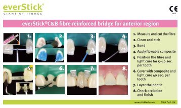 everStick®C&B fibre reinforced bridge for anterior region ... - StickTech