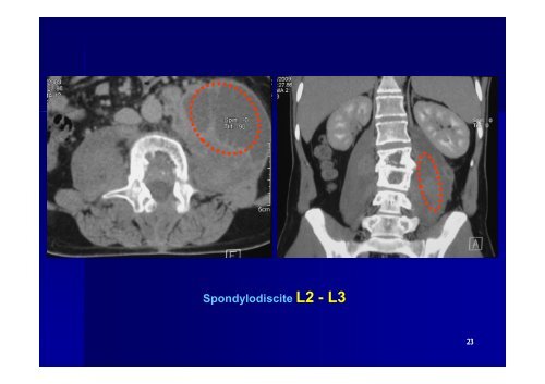 Les Spondylodiscites. Pr Akhaddar. 2010 [Mode de ... - medramo