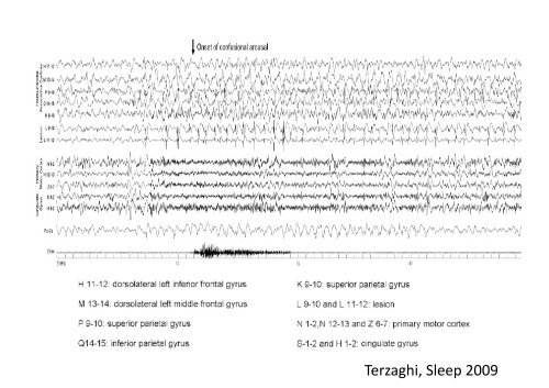 Parasomnies de sommeil lent profond - SPLF