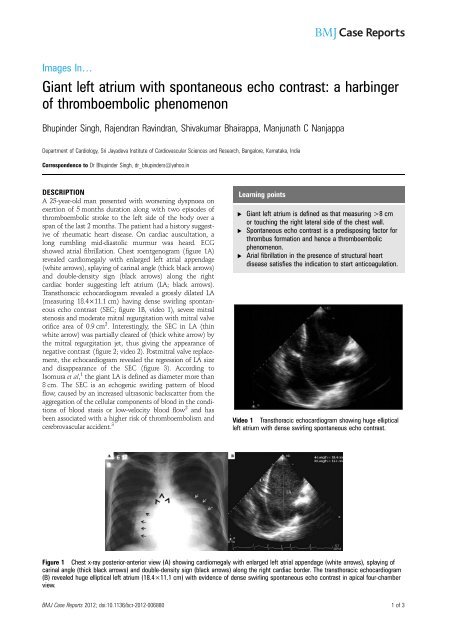 Giant left atrium with spontaneous echo contrast: a harbinger of ...