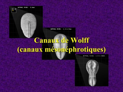 Diagnostic échographique des Malformations utérines