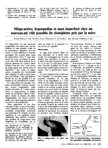 Mega-uretre, hypospadias et anus imperfore chez un