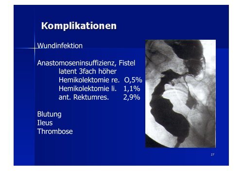 Vorlesung über das kolorektale Karzinom (PDF 8,7 MB) - Volker Nutz