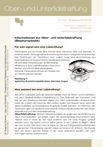 Ober- und Unterlidstraffung - Dr. med. Susanne Schinner