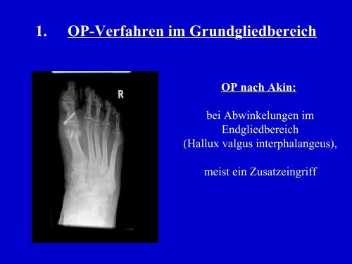 Fusschirurgie-Patienteninfo - Dr. med. Eckhardt Krieger