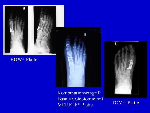 Fusschirurgie-Patienteninfo - Dr. med. Eckhardt Krieger