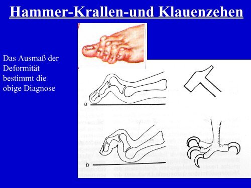 Fusschirurgie-Patienteninfo - Dr. med. Eckhardt Krieger