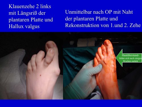 Fusschirurgie-Patienteninfo - Dr. med. Eckhardt Krieger