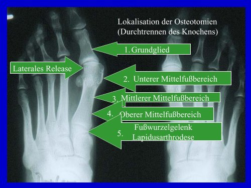 Fusschirurgie-Patienteninfo - Dr. med. Eckhardt Krieger