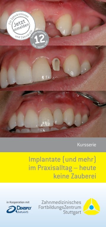 Implantate (und mehr) im Praxisalltag – heute keine ... - ZFZ Stuttgart