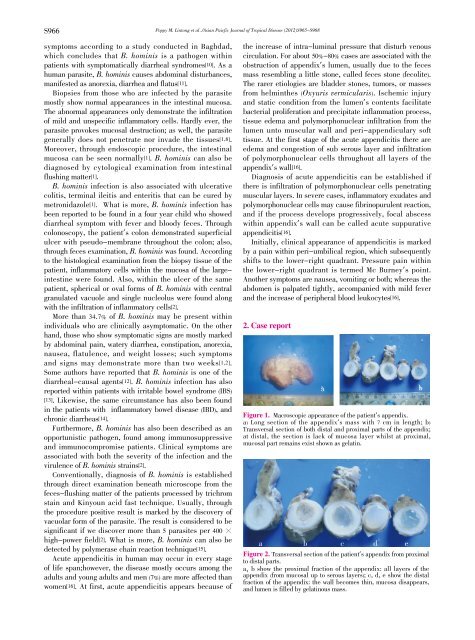 Acute suppurative appendicitis with Blastocystis hominis