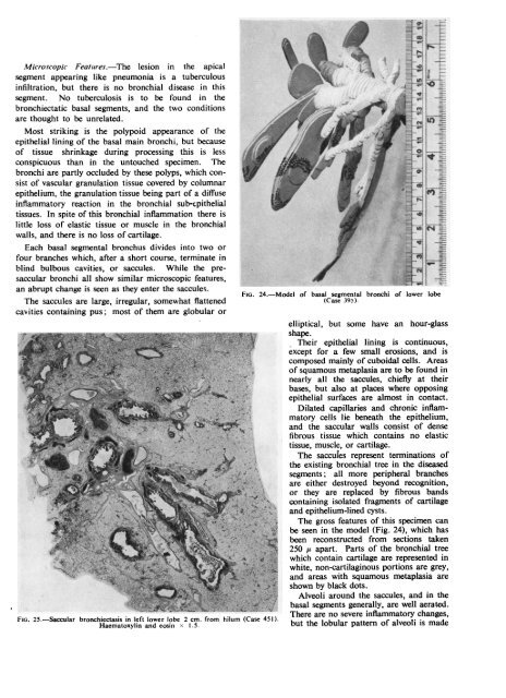 A study of the pathology and pathogenesis of bronchiectasis.