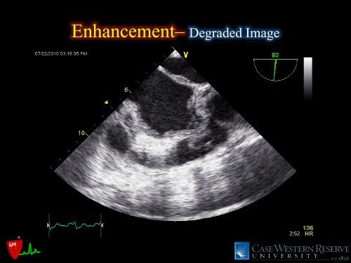 Common Intraoperative Ultrasound Artifacts - Casecag.com