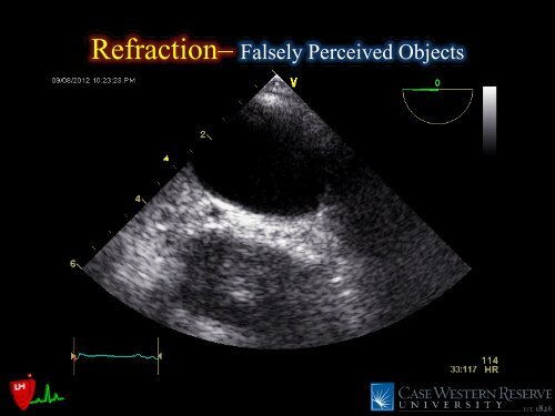 Common Intraoperative Ultrasound Artifacts - Casecag.com