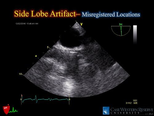 Common Intraoperative Ultrasound Artifacts - Casecag.com