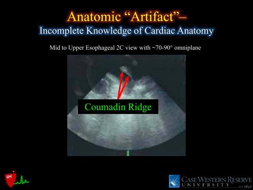 Common Intraoperative Ultrasound Artifacts - Casecag.com