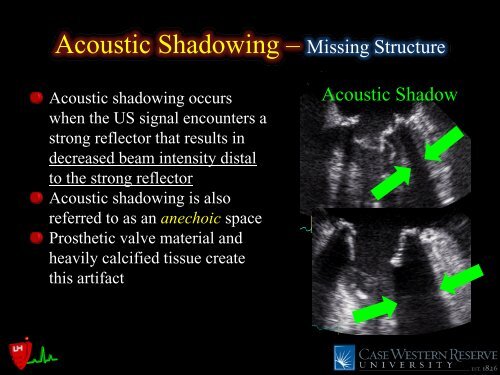 Common Intraoperative Ultrasound Artifacts - Casecag.com