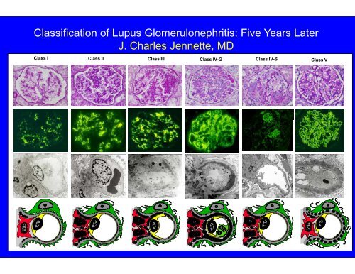 Classification of Lupus Glomerulonephritis: Five Years Later