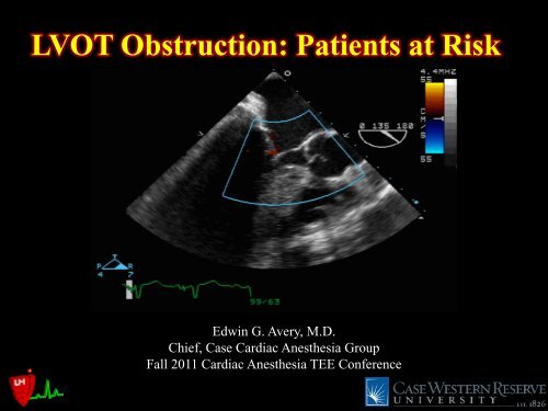 LVOT Obstruction: Patients at Risk - Casecag.com