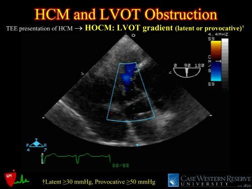 LVOT Obstruction: Patients at Risk - Casecag.com