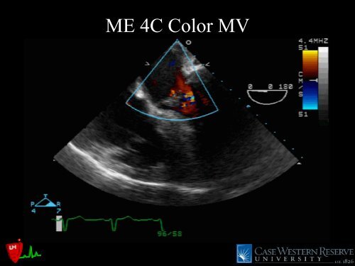 LVOT Obstruction: Patients at Risk - Casecag.com