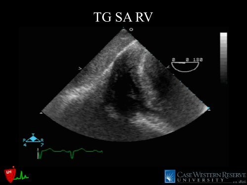 LVOT Obstruction: Patients at Risk - Casecag.com