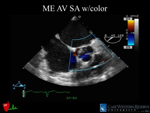 LVOT Obstruction: Patients at Risk - Casecag.com