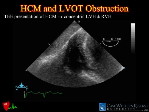 LVOT Obstruction: Patients at Risk - Casecag.com