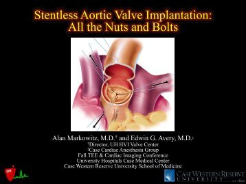 Stentless Aortic Valve Implantation: All the Nuts and ... - Casecag.com