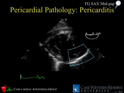 Pericardial Pathology - Casecag.com