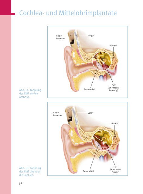 Cochlea - Med-El