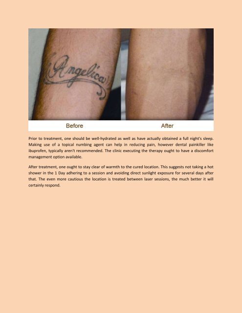 How you can Have A Successful Laser Tattoo Removal