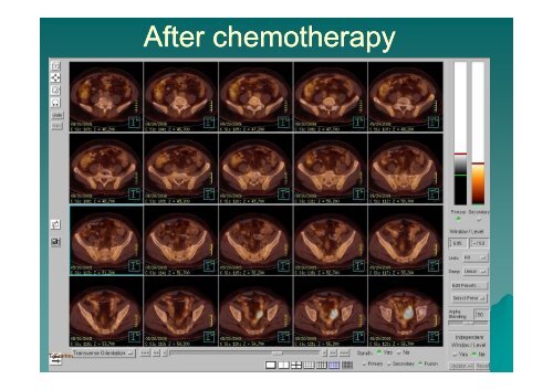 Role of PET Role of PET-CT in Pulmonary Malignancy